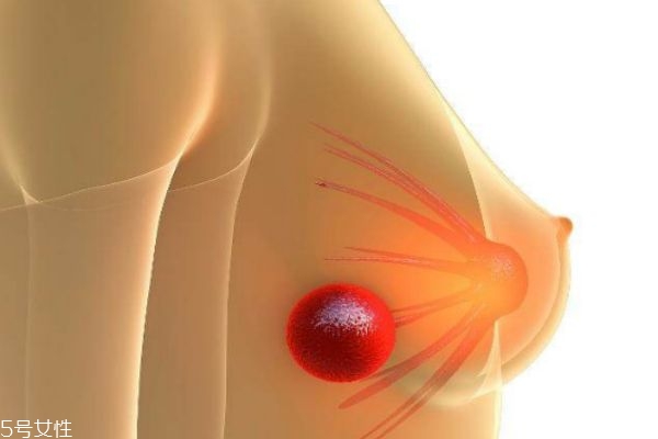 乳腺結節(jié)可以消除嗎 什么樣的乳腺結節(jié)屬于乳腺癌
