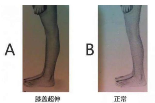 膝關(guān)節(jié)超伸的表現(xiàn) 快來自測(cè)一下把