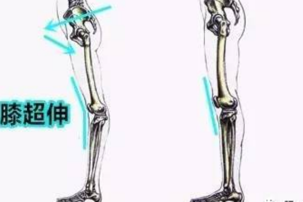 膝關(guān)節(jié)超伸的表現(xiàn) 快來自測(cè)一下把
