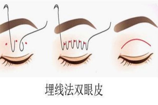埋線雙眼皮感染怎么辦？埋線雙眼皮發(fā)炎了怎么辦