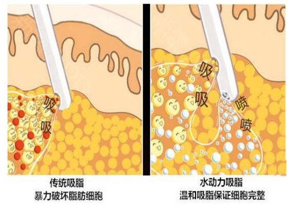 什么是水動(dòng)力吸脂呢 水動(dòng)力吸脂有什么用呢