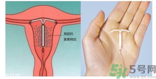 上環(huán)是什么意思？上環(huán)后注意事項(xiàng)有哪些？