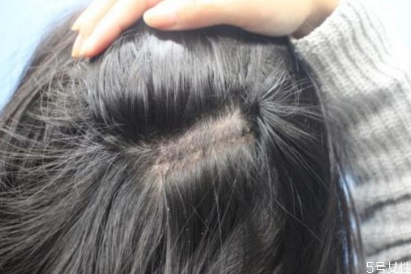 為什么會(huì)長白頭發(fā)呢 白頭發(fā)形成的原因有什么呢