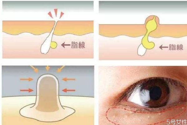 脂肪粒是怎么形成的呢 脂肪?？梢宰约汉脝?></p><h3</div>
<p class=