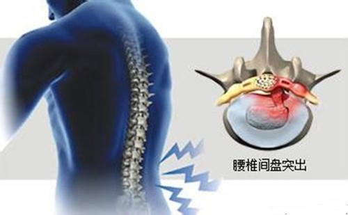 什么是腰間盤(pán)突出 腰間盤(pán)突出壓迫神經(jīng)腿疼怎么辦