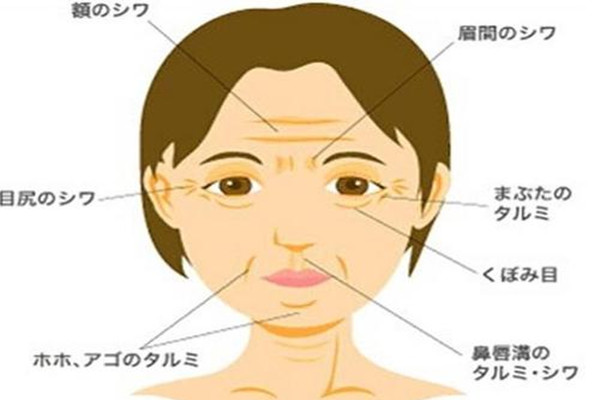 笑紋和魚尾紋的區(qū)別 笑紋只有笑的時候才有嗎