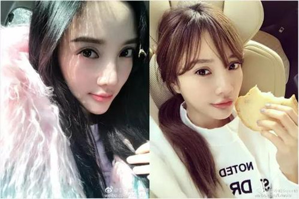 壓雙眼皮價格受什么影響 壓雙眼皮術后要注意什么