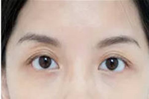 韓式去眼袋第二天會腫嗎 韓式去眼袋的注意事項(xiàng)