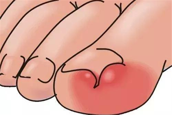 甲溝炎會(huì)長手上嗎 手上的甲溝炎怎么處理