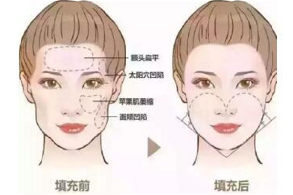 自體脂肪填充需要穿塑身衣嗎 自體脂肪填充都有哪些過(guò)程