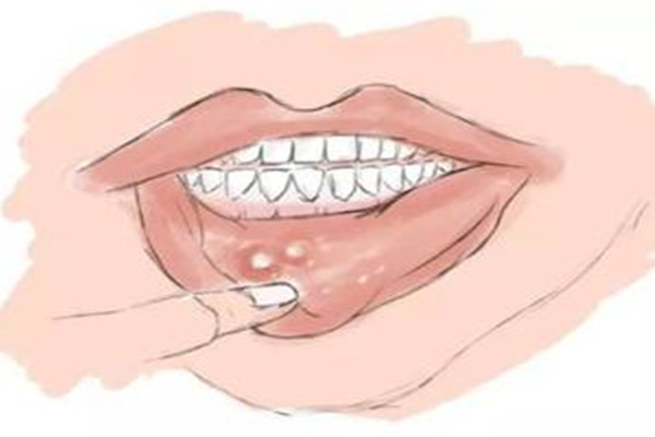口腔潰瘍會導(dǎo)致臉腫嗎 口腔潰瘍會導(dǎo)致喉嚨痛嗎