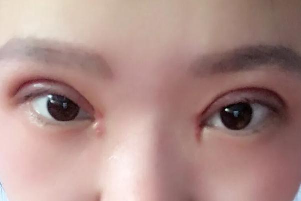 開眼角的恢復期是多久 開眼角要多久才能恢復正常