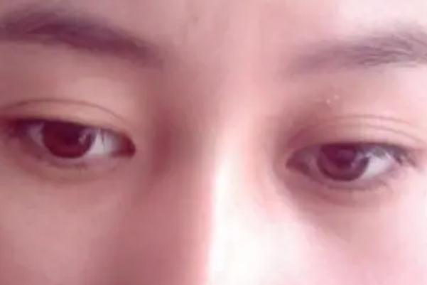 開(kāi)眼角會(huì)顯老嗎 開(kāi)眼角對(duì)眼睛有危害嗎