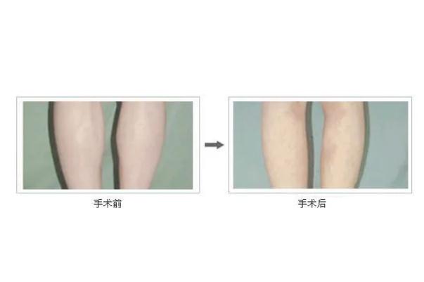 瘦腿針會(huì)導(dǎo)致靜脈曲張嗎 瘦腿針能維持多長時(shí)間