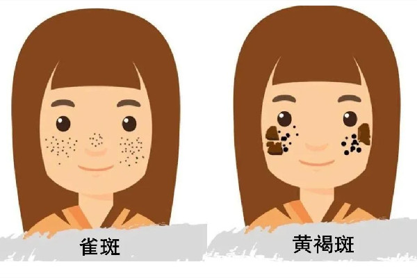 皮秒祛斑會反彈嗎 皮秒祛斑后要注意什么事項(xiàng)
