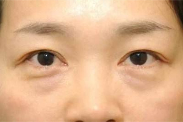 武漢去眼袋最好醫(yī)院排名 武漢去眼袋手術(shù)費用大概多少錢